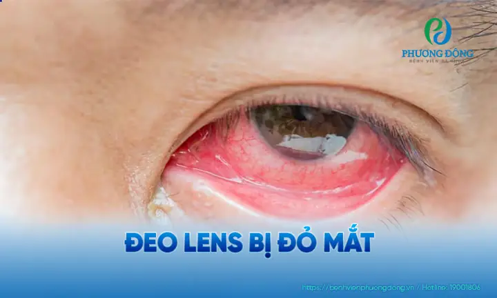 Các Bệnh Về Mắt Khi Đeo Kính Áp Tròng