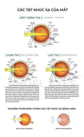 Cách Đo Kính Áp Tròng Vừa Với Mắt