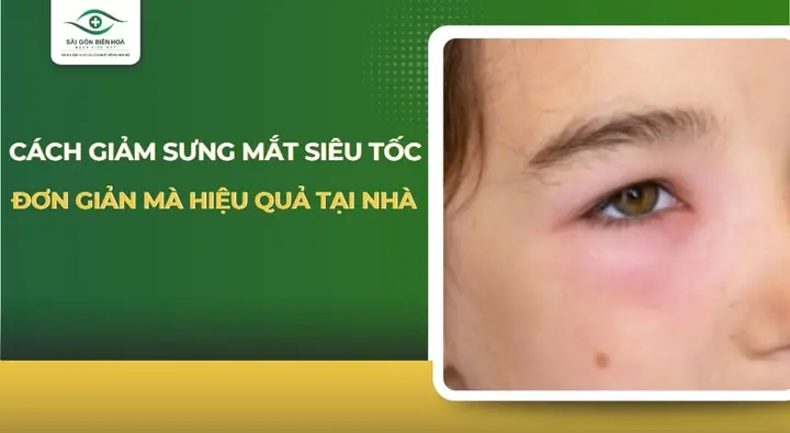 Cách Làm Giảm Sưng Mắt Đeo Kính