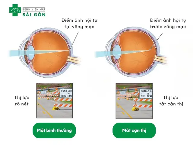 Cách Vẽ Vậy Qua Kính Cận Và Mắt Lý 9