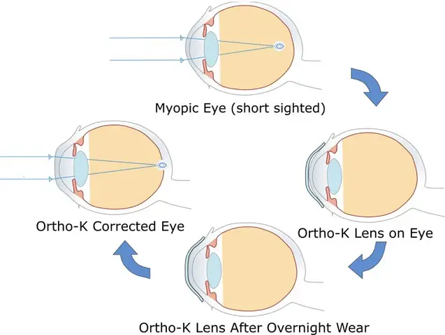Chữa Mắt Cận Bằng Kính Áp Tròng