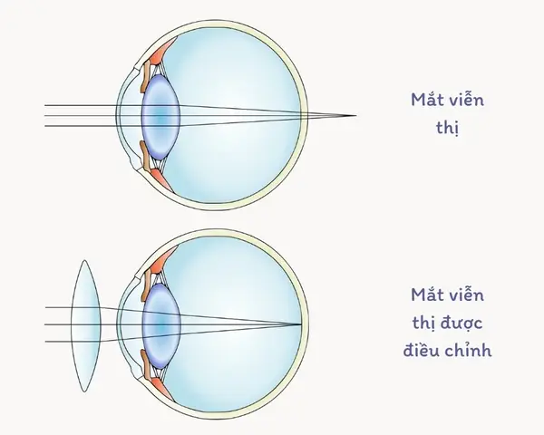 Dđể Khắc Phục Tật Mắt Lão Phải Đeo Kính Gì