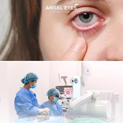 Đeo Kính Áp Tròng Có Mổ Mắt Được Không Đeo Kính Áp Tròng Có Mổ Mắt Được Không