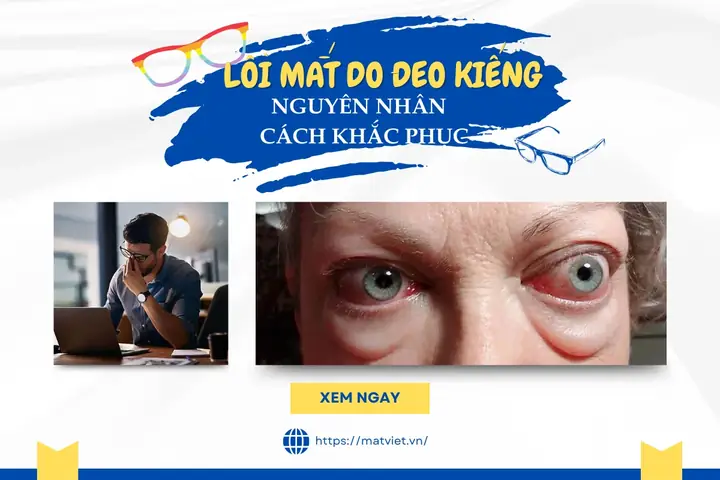 Đeo Kính Cận Có Bị Lồi Mắt Không