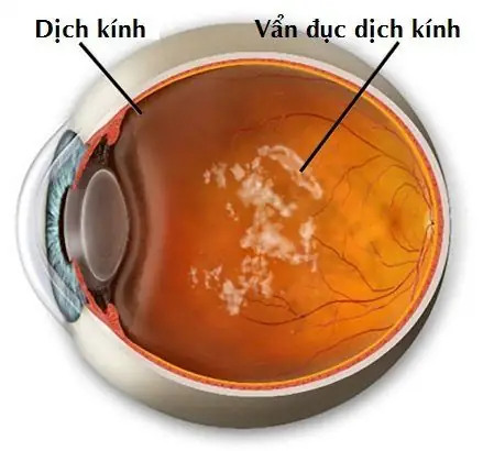 Dịch Kính Mắt Dịch Sang Tiếng Anh