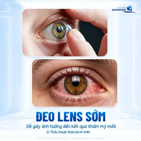 Dùng Kính Áp Tròng Có Ảnh Hưởng Đến Mắt Dùng Kính Áp Tròng Có Ảnh Hưởng Đến Mắt