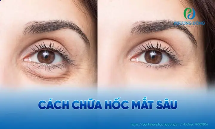 Đường Kính Gian Hốc Mắt