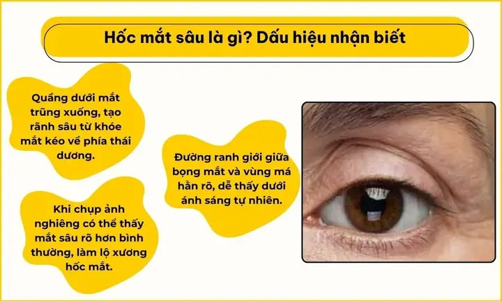 Đường Kính Gian Hốc Mắt