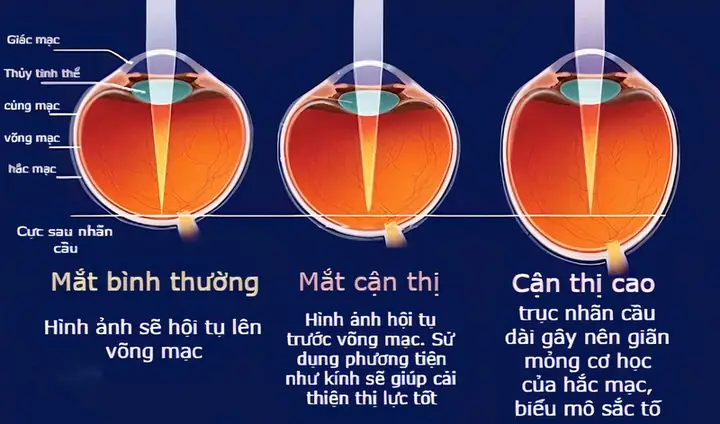 Hình Ảnh Đeo Kính Tốt Cho Mắt Cận Hình Ảnh Đeo Kính Tốt Cho Mắt Cận