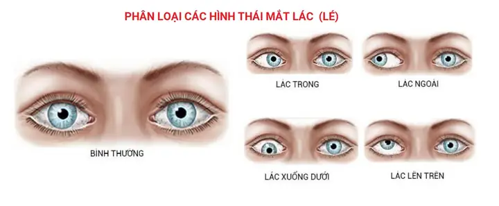 Hình Mắt Kính 1 Mắt Có Dây