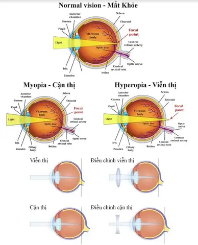 Khắc Phục Mắt Cận Thị Đeo Kính Gì