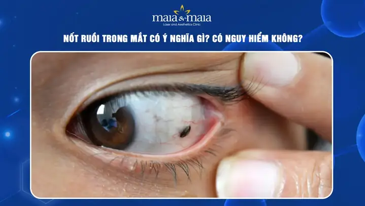 Kính Cận Mắt Ruồi Nam