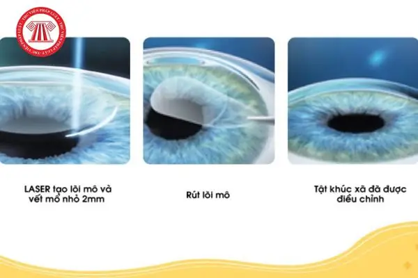 Kính Laser Mống Mắt
