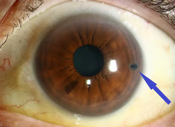 Kính Laser Mống Mắt