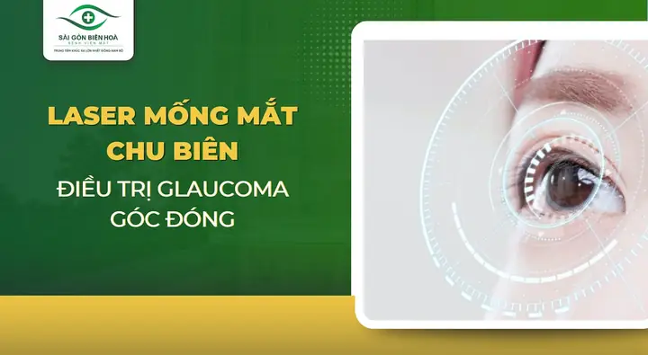 Kính Laser Mống Mắt