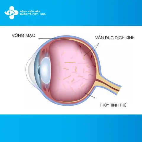 Kính Mắt Ruồi Trong Suốt