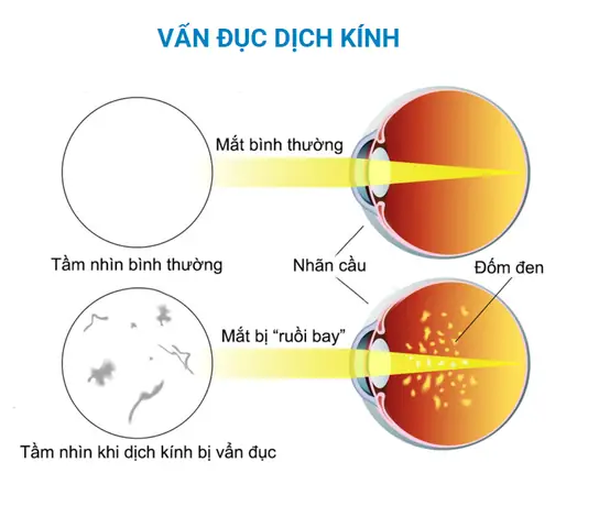 Kính Mắt Ruồi Trong Suốt