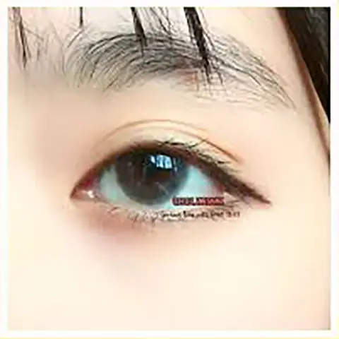 Mắt Đeo Kính Bị Dại