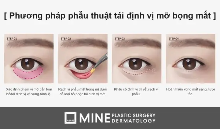 Mắt Kính Định Vị