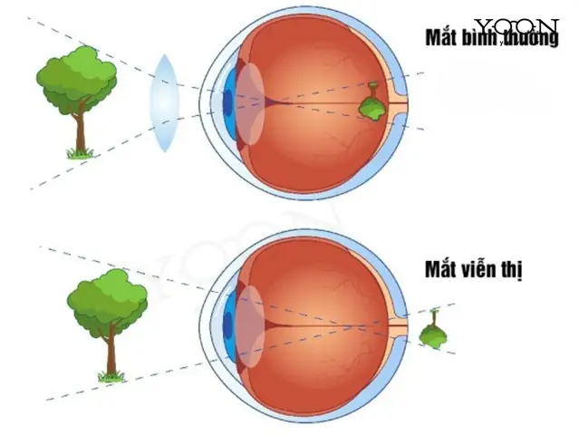 Mắt Là Thấu Kính Gì