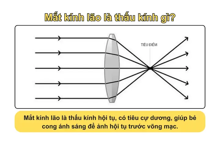 Mắt Người Là Thấu Kính Gì