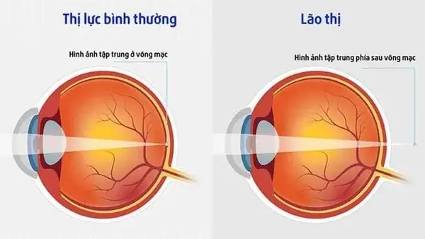 Mắt Người Là Thấu Kính Gì