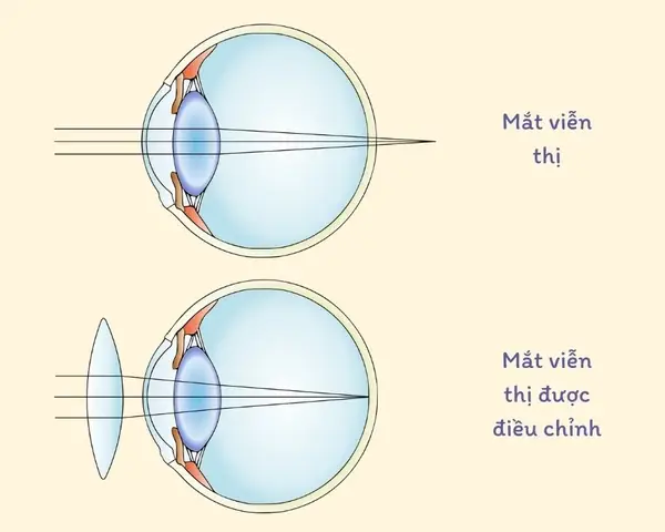 Thấu Kính Của Mắt