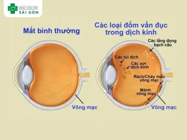 Vẩn Đục Dịch Kính Mắt
