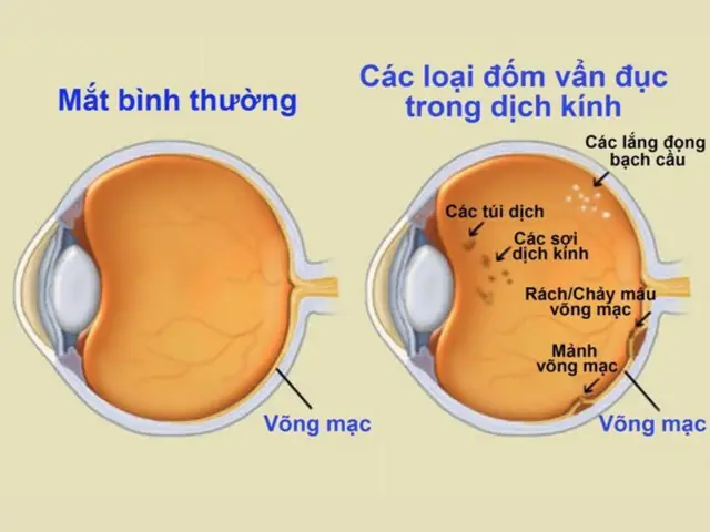 Vẩn Đục Dịch Kính Mắt